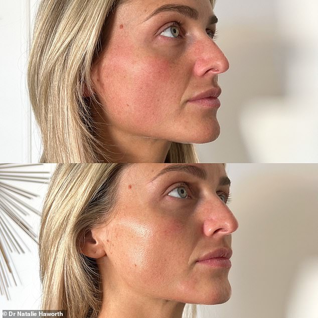 Before and after: As well as the tear duct filler, Claudia opted for chin/jaw fillers, anti-wrinkle injections, an Aquatite facial and a laser hair removal course, costing an average of £2500